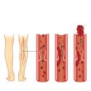 KneeEase - Schmerzlindernde Knieschiene mit natürlicher Wärmestimulation