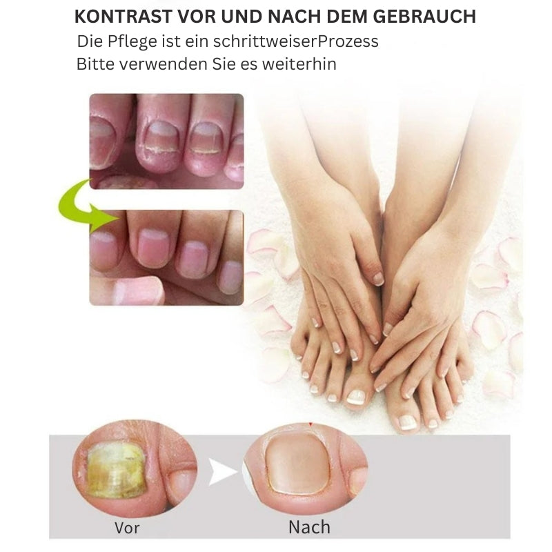 NailRenew - Schnelle Nagelreparaturbehandlung für stärkere und gesündere Nägel